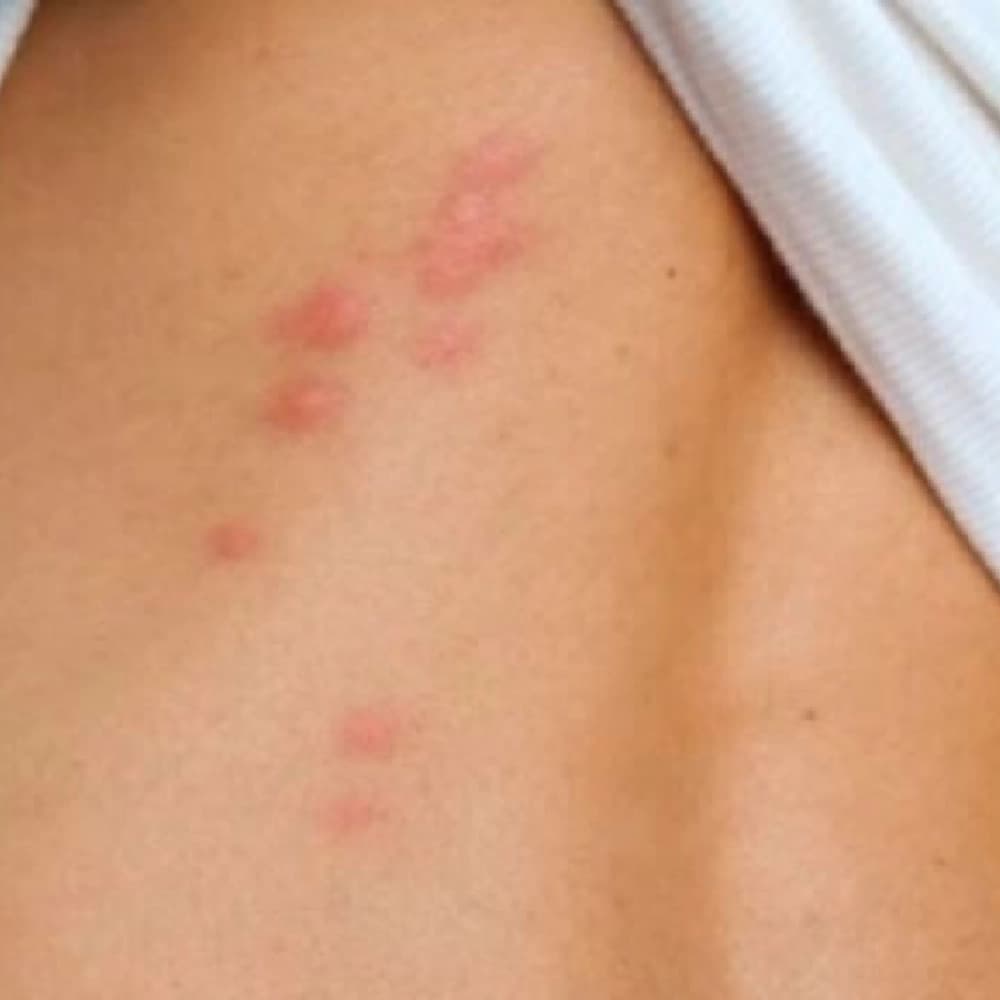 Piqûres de punaises de lit alignées sur la peau, signe d'infestation à Vénissieux