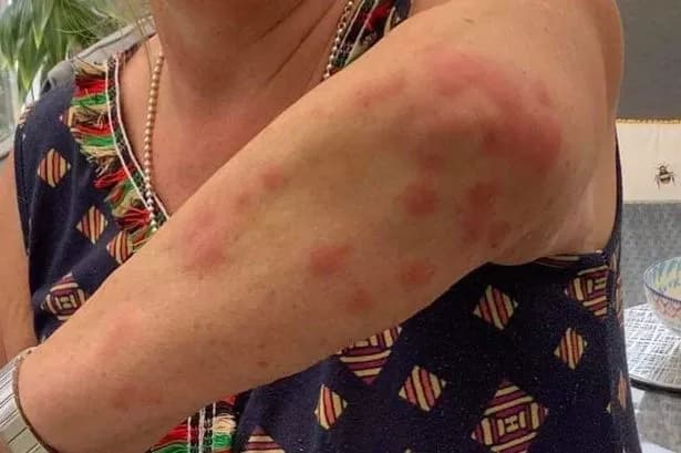 Piqûres de punaises de lit sur la peau