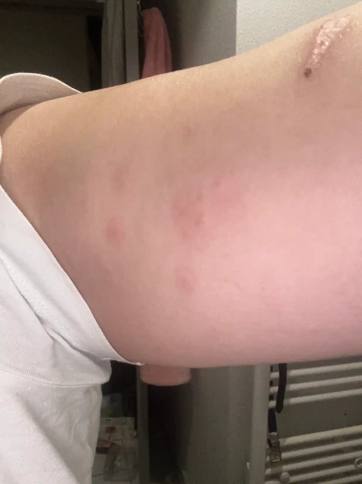 Exemple de piqûres de punaises de lit sur la peau